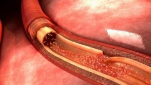 Aortadissektion: Hvad det er og hvad der forårsager det