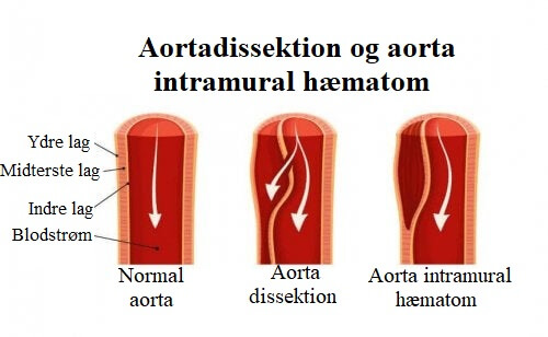 Aortadissektion og aorta intramural hæmatom