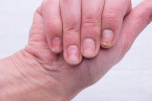 Naturlige midler mod gule negle