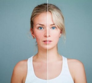 7 fødevarer til at forbedre rosacea