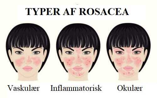 Forskellige typer af rosacea