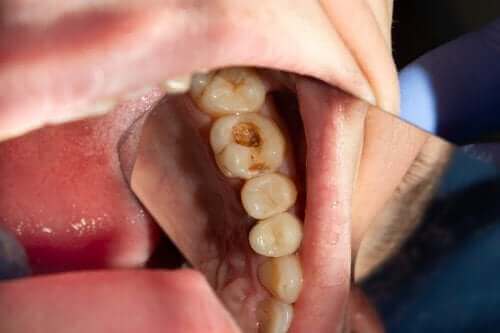 De mulige årsager til huller i tænderne