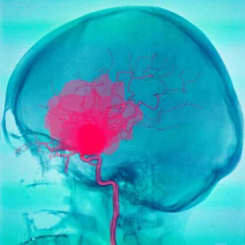 Tegning af cerebral parese