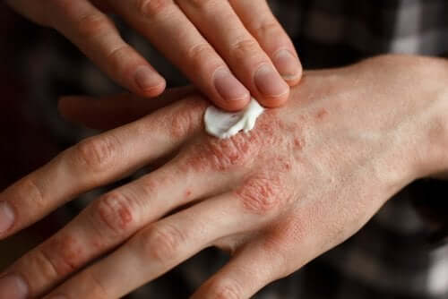 Person kommer creme på hånd med psoriasis