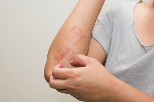 I sin mest almindelige form manifesterer psoriasis sig som tykke, rødlige hudpletter, der forårsager kløe og ubehag