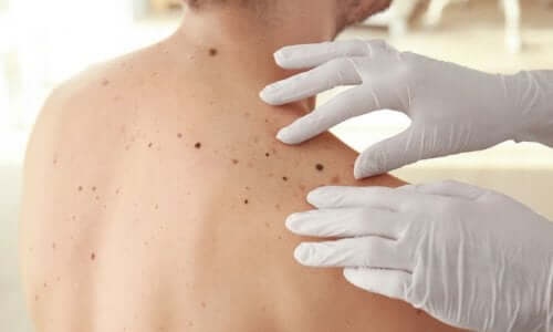 Læge anvender ABCDE-testen for hudkræft