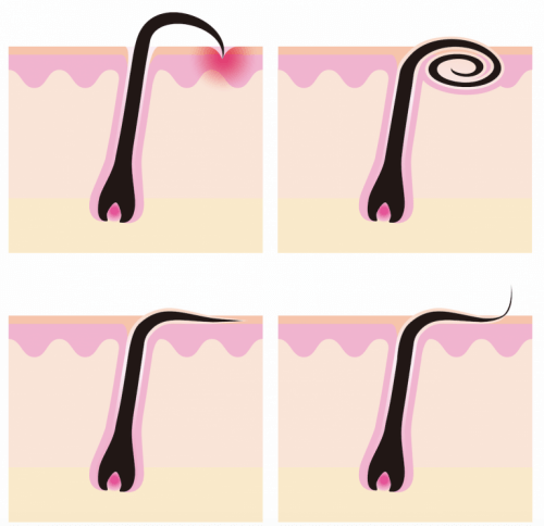 Illustration af nedgroede hår