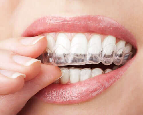 Kvinde anvender gennemsigtige tandskinner