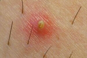 Sådan kan man forhindre nedgroede hår