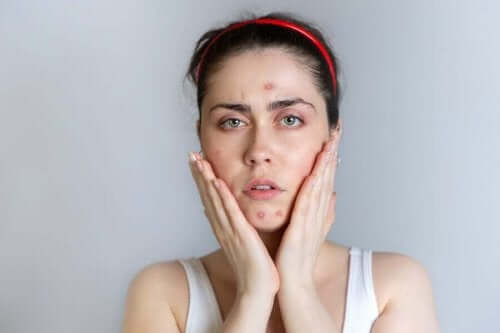 Kvinde oplever akne under menstruation
