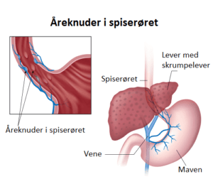 Tegn og symptomer på åreknuder i spiserøret
