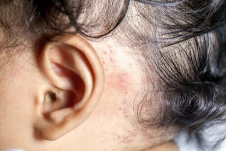 Psoriasis hos børn: En baby med psoriasis