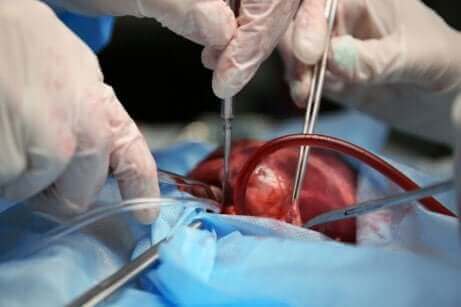 Læger, der opererer et hjerte