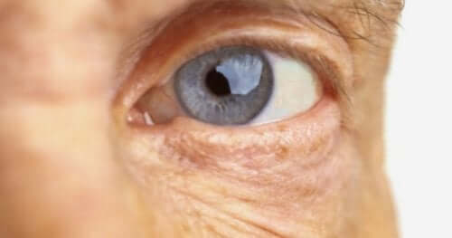 Nærbillede af øje efter operation af grå stær