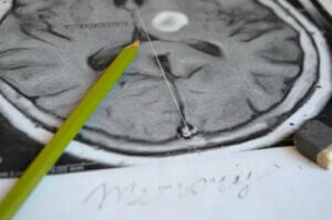 Amnesi: Symptomer og forebyggelse