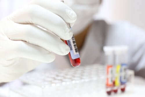 Blodprøver tjekker for hypocalcæmi