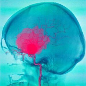 Subarachnoid og subdural blødninger