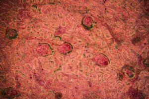 Nyretuberkulose: Diagnose og behandling