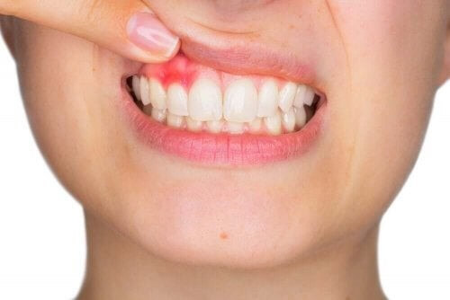 Kvinde med tandkødsbetændelse 