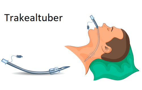 Illustration af anvendelse af trakealtuber