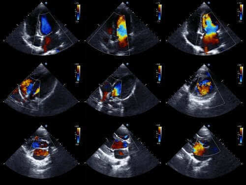 Ekkokardiogrammer er en af ​​de mest effektive teknikker til at diagnosticere medfødte hjerteproblemer