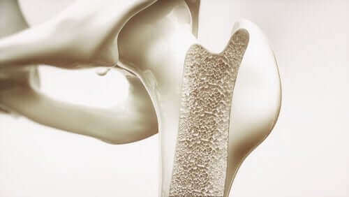 Knogle med osteoporose