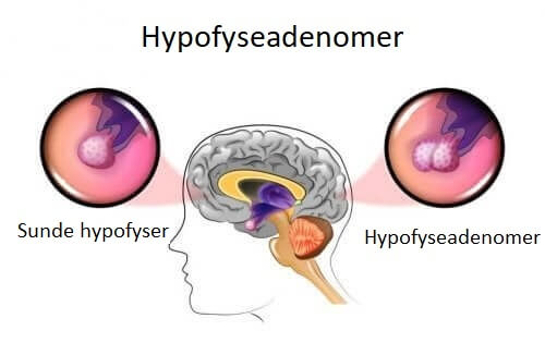 Hypofyseadenomer: Årsager og symptomer