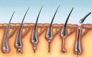 Multipel pilomatrixoma syndrom