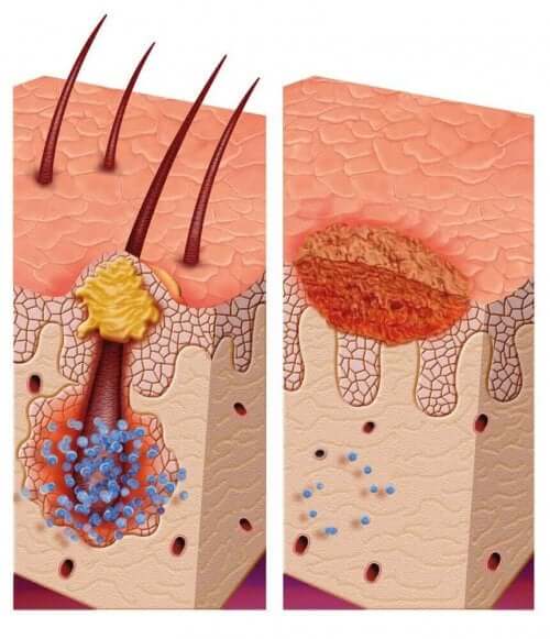 Illustration af multipel pilomatrixoma