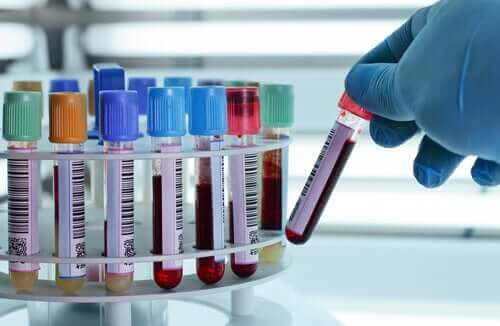 Laborant håndterer blodprøver med dyb venetrombose