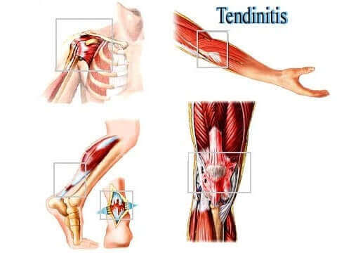 Tendinitis er en irritation i senen