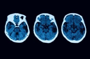 Diagnosticering og behandling af posterior kortikal atrofi