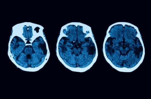 Diagnosticering og behandling af posterior kortikal atrofi