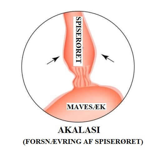 Akalasi illustreres med tegning af mavesæk og spiserør