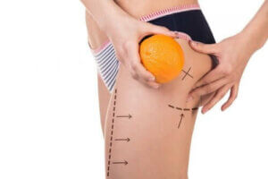 Tre menuer til forebyggelse af cellulitis