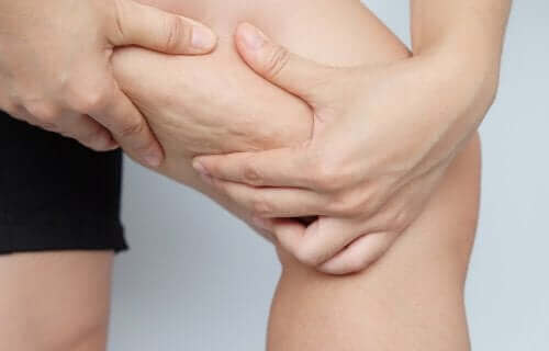 Cellulitis er en tilstand, hvor der opstår små buler og fordybninger i huden.