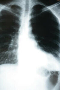 Hvordan lungebetændelse påvirker kroppen