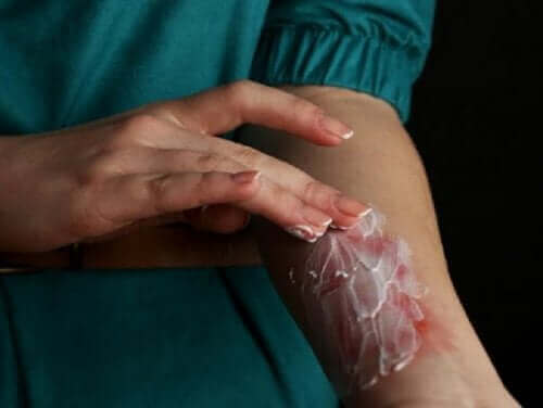 Rengøring af forbrændingen sammen med påføring af regenererende cremer vil fremme heling