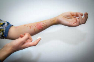 Behandling af en overfladisk forbrænding