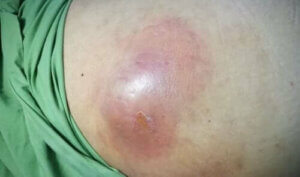 Hvad er intraabdominale abscesser?