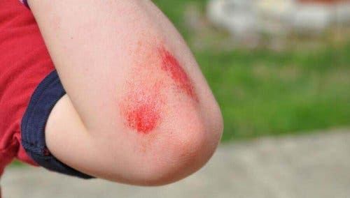 Person med skrammer på albue