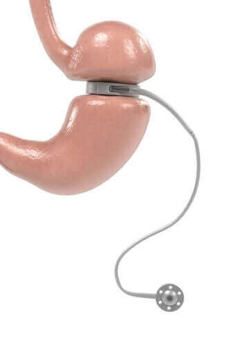 Justerbar gastrisk banding - anvendelser og egenskaber