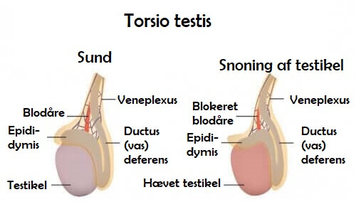 Torsio testis: Symptomer og årsager