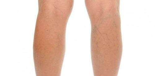 Venoruton hjælper på åreknuder