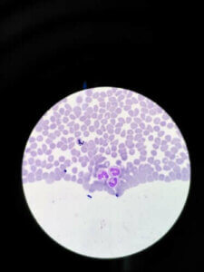 Agranulocytose: Symptomer og behandling