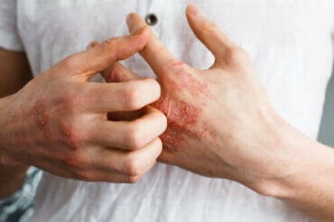 Hvad er atopisk dermatitis?