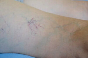 Venoruton - Egenskaber og anvendelse