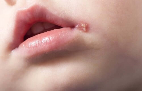 De fleste primære infektioner med forkølelsessår finder normalt sted i barndommen