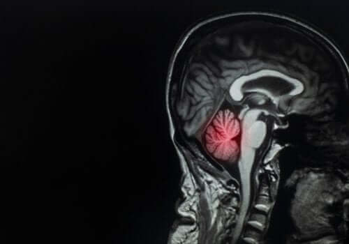 Hjernemetastaser: Beskrivelse og behandling