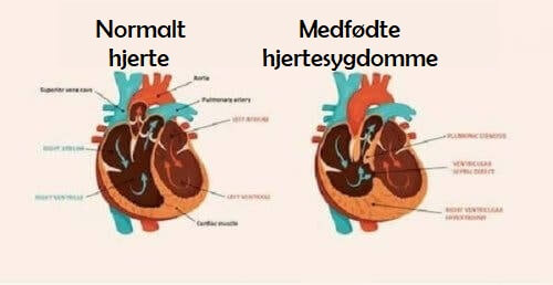 Illustration af medfødte hjertesygdomme